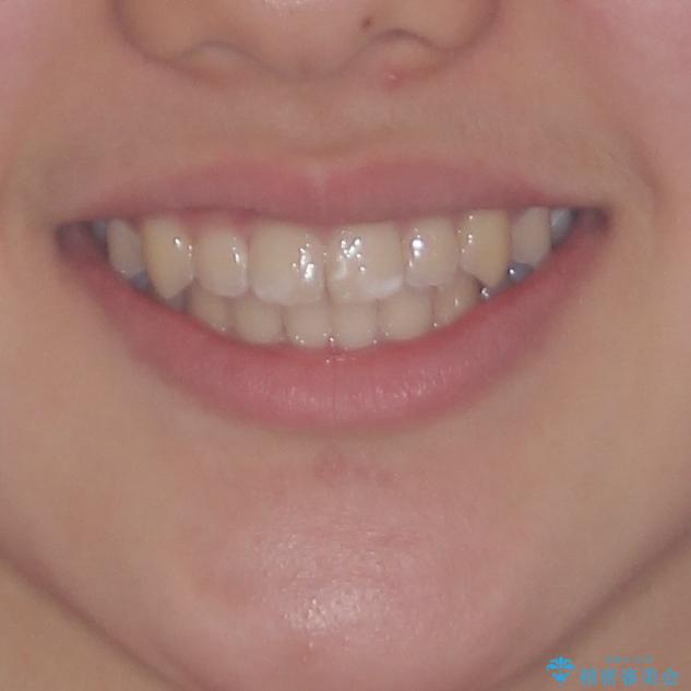 遠方から新幹線で通院 急速拡大装置とインビザラインによる矯正治療の治療後(顔貌)
