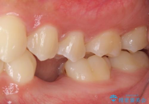 乳歯を抜いてインプラントに 咬み合わせ改善のインビザライン矯正の治療中