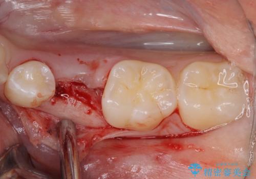 乳歯を抜いてインプラントに　咬み合わせ改善のインビザライン矯正の治療前