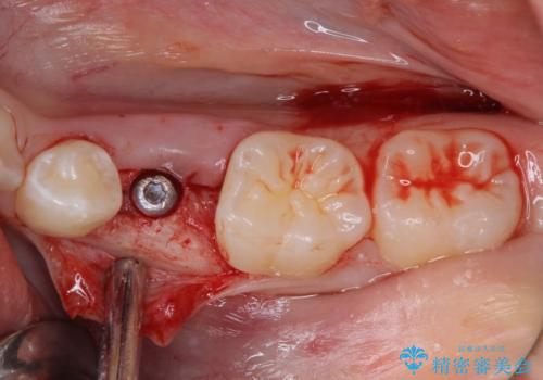 乳歯を抜いてインプラントに 咬み合わせ改善のインビザライン矯正の治療中
