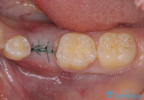 乳歯を抜いてインプラントに 咬み合わせ改善のインビザライン矯正の治療後