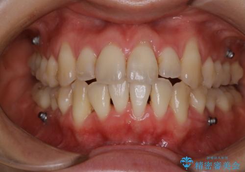 インビザライン中の方 結婚式前にPMTCでステインの除去