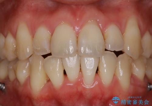 インビザライン中の方 結婚式前にPMTCでステインの除去の治療前