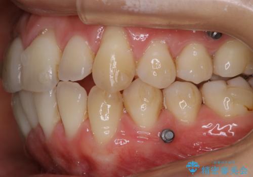 インビザライン中の方 結婚式前にPMTCでステインの除去の治療前