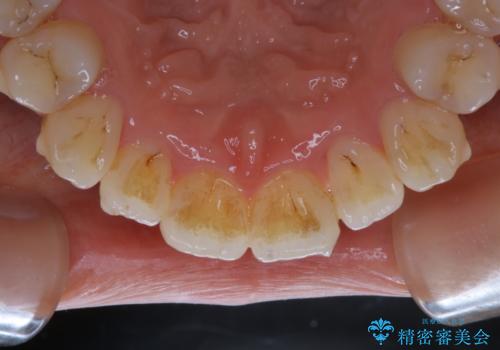 インビザライン中の方 結婚式前にPMTCでステインの除去の治療前