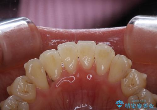 インビザライン中の方 結婚式前にPMTCでステインの除去の治療前