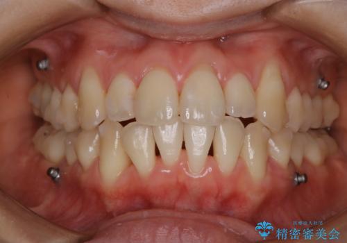 インビザライン中の方 結婚式前にPMTCでステインの除去の治療後