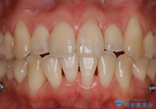 インビザライン中の方 結婚式前にPMTCでステインの除去の治療後
