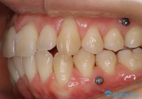 インビザライン中の方 結婚式前にPMTCでステインの除去の治療後