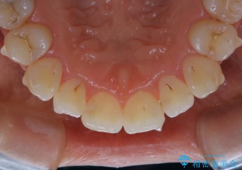 インビザライン中の方 結婚式前にPMTCでステインの除去の治療後