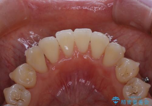 インビザライン中の方 結婚式前にPMTCでステインの除去の治療後