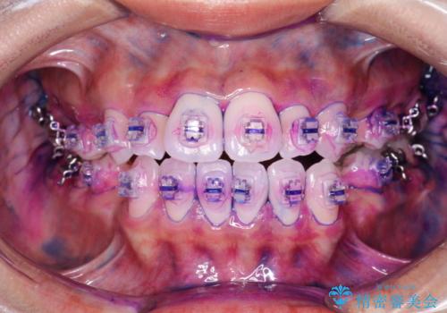 ワイヤー矯正治療中に気になる口臭をPMTCで予防の治療前