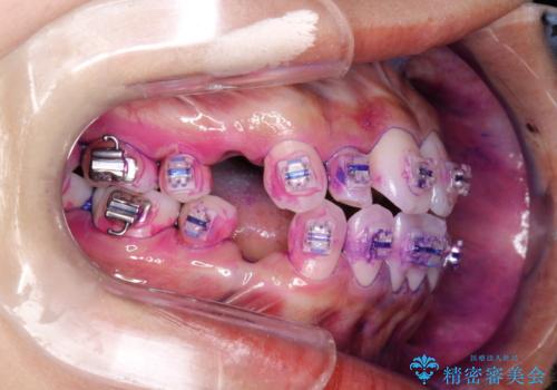 ワイヤー矯正治療中に気になる口臭をPMTCで予防の治療前