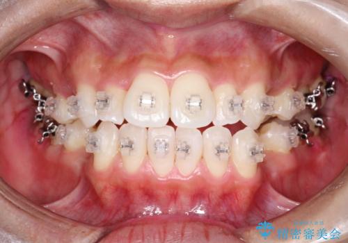 ワイヤー矯正治療中に気になる口臭をPMTCで予防の治療後