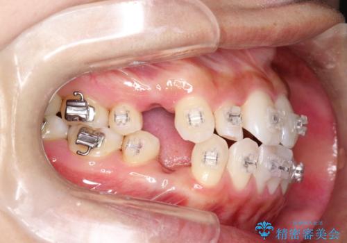 ワイヤー矯正治療中に気になる口臭をPMTCで予防の治療後