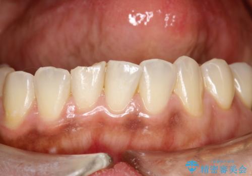 妊娠中(5カ月)にPMTCでオーラルケアの治療前