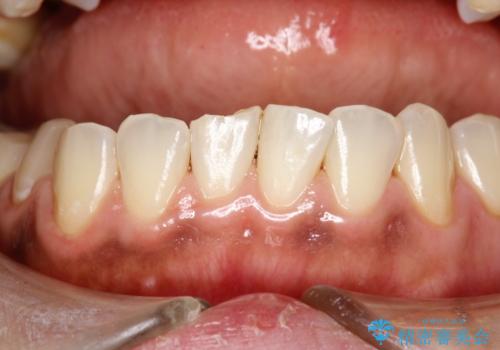 妊娠中(5カ月)にPMTCでオーラルケアの治療後