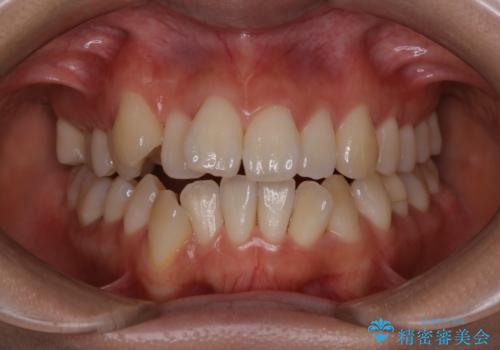 矯正治療開始前にPMTCでツルツルの歯にの治療前