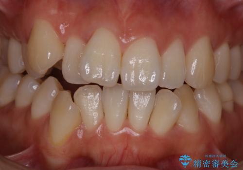 矯正治療開始前にPMTCでツルツルの歯にの治療前