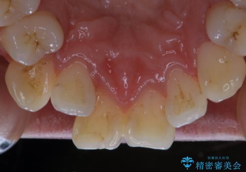 矯正治療開始前にPMTCでツルツルの歯にの治療前