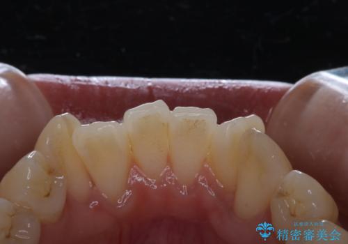 矯正治療開始前にPMTCでツルツルの歯にの症例 治療前