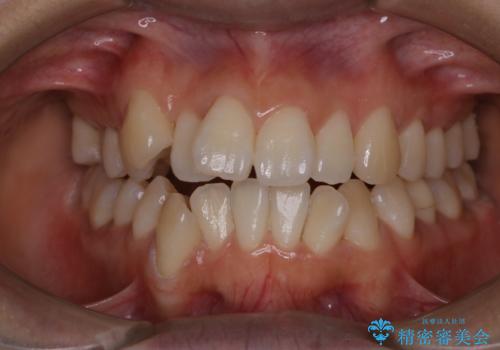 矯正治療開始前にPMTCでツルツルの歯にの治療後
