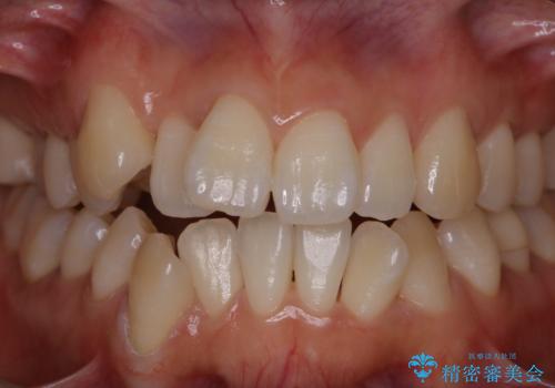 矯正治療開始前にPMTCでツルツルの歯にの治療後