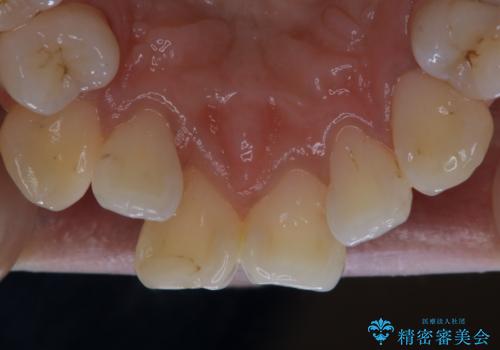 矯正治療開始前にPMTCでツルツルの歯にの治療後