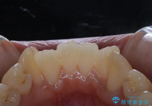 矯正治療開始前にPMTCでツルツルの歯にの症例 治療後