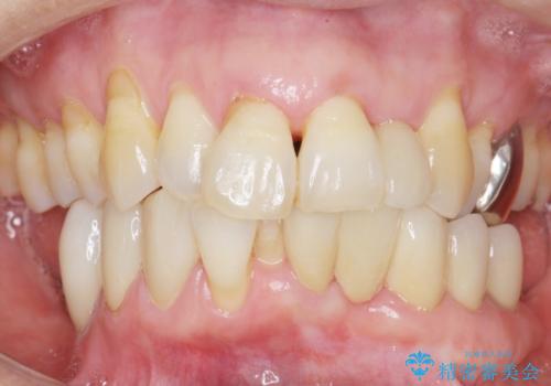 歯の動揺が気になる 低予算ではやく治したい 50代女性の治療後