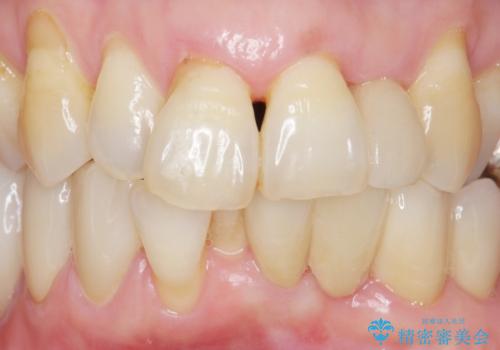 歯の動揺が気になる 低予算ではやく治したい 50代女性の治療後