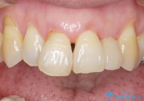 歯の動揺が気になる 低予算ではやく治したい 50代女性の治療後