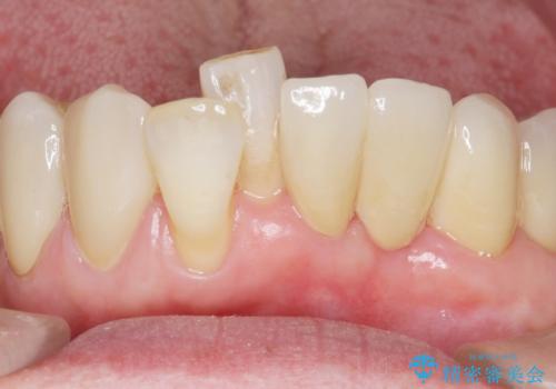 歯の動揺が気になる 低予算ではやく治したい 50代女性の治療後