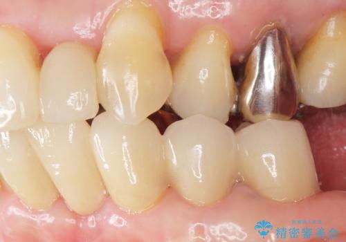 歯の動揺が気になる 低予算ではやく治したい 50代女性の治療後