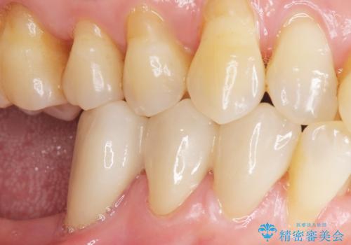 歯の動揺が気になる 低予算ではやく治したい 50代女性の治療後