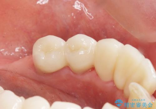 歯の動揺が気になる 低予算ではやく治したい 50代女性の治療後