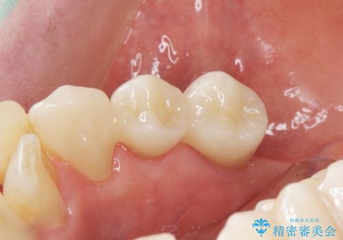 歯の動揺が気になる 低予算ではやく治したい 50代女性の治療後