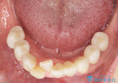 歯の動揺が気になる 低予算ではやく治したい 50代女性の治療後