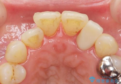 歯の動揺が気になる 低予算ではやく治したい 50代女性の治療後