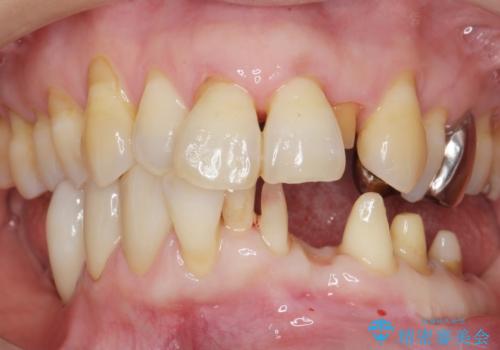 歯の動揺が気になる 低予算ではやく治したい 50代女性の治療中