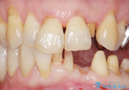 歯の動揺が気になる 低予算ではやく治したい 50代女性の治療中