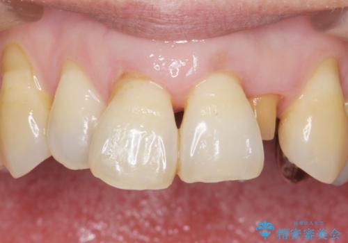 歯の動揺が気になる 低予算ではやく治したい 50代女性の治療中