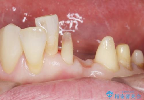 歯の動揺が気になる 低予算ではやく治したい 50代女性の治療中
