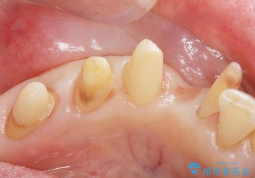 歯の動揺が気になる 低予算ではやく治したい 50代女性の治療中