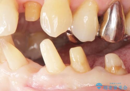 歯の動揺が気になる 低予算ではやく治したい 50代女性の治療中