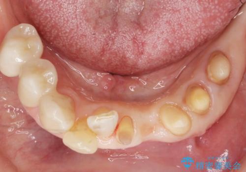 歯の動揺が気になる 低予算ではやく治したい 50代女性の治療中