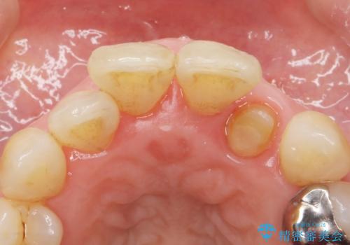 歯の動揺が気になる 低予算ではやく治したい 50代女性の治療中