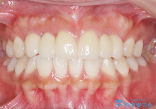 歯の位置異常 はやく治したい 矯正は嫌 20代女性の治療後