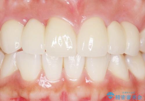 歯の位置異常 はやく治したい 矯正は嫌 20代女性の治療後