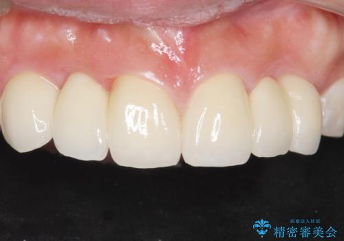 歯の位置異常 はやく治したい 矯正は嫌 20代女性の治療後